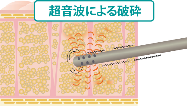 超音波破砕（ベイザー）