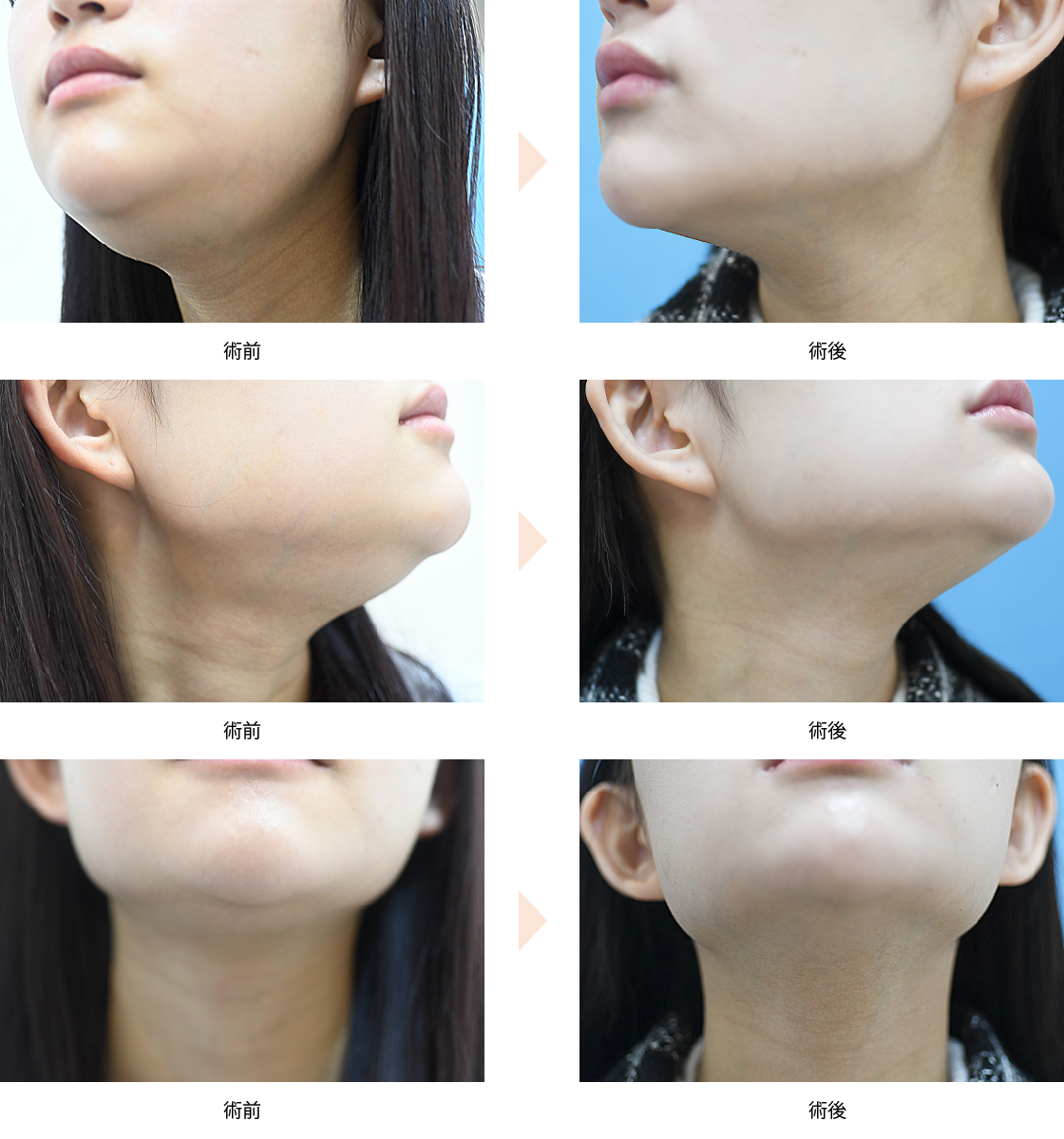 「唾液腺ボトックスによる小顔治療（舌下腺・顎下腺）」の症例写真・ビフォーアフター