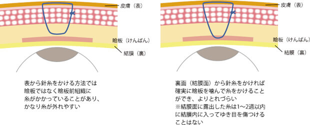 糸の固定源