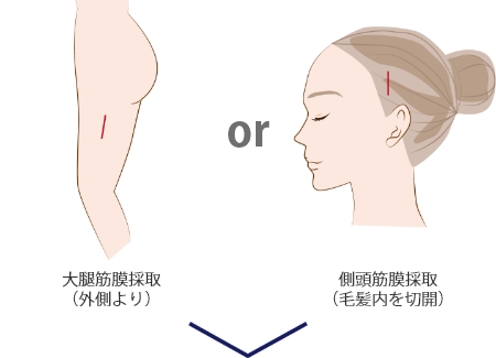 大腿筋膜採取or側頭筋膜採取