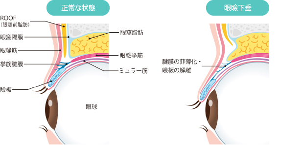 眼瞼下垂の原因