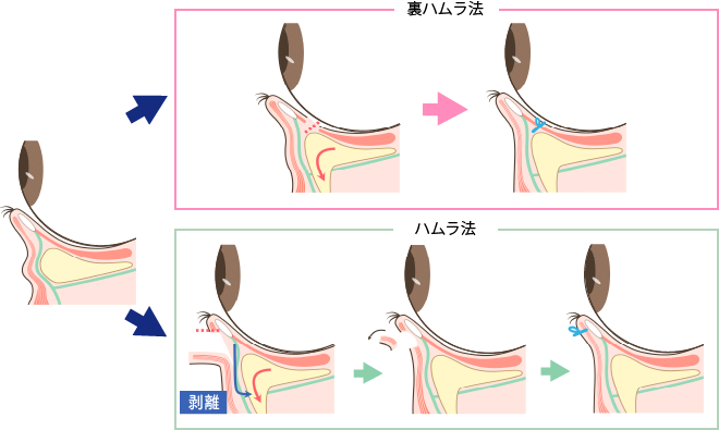 裏ハムラ法とハムラ法の違い