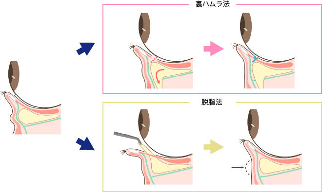 裏ハムラ法と脱脂法の違い