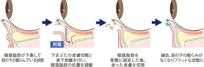 ハムラ法