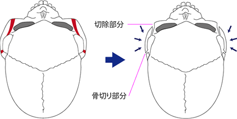 頬骨弓部の張り出しが原因