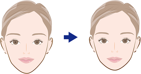 おとがい骨切り術が適応となる症状