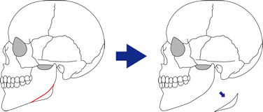 エラ（下顎角）骨切り術