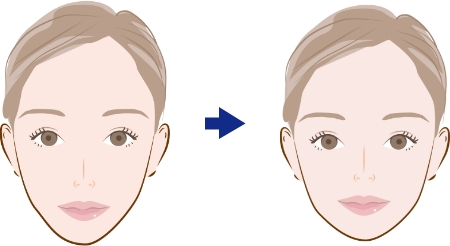 ルフォーＩ型骨切り術（上顎骨切り術）が適応となる症状