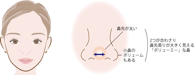 にんにく鼻