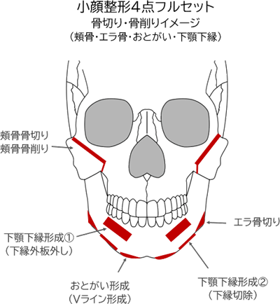 ルフォーによって骨切りを行う部位（上あご）