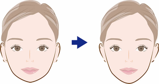 Vライン形成術・小顔整形が適応となる症状