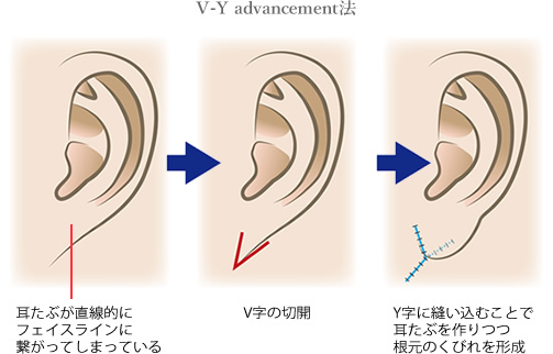 手術のイメージ