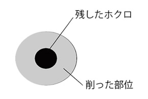 大きなほくろを小さくしたい