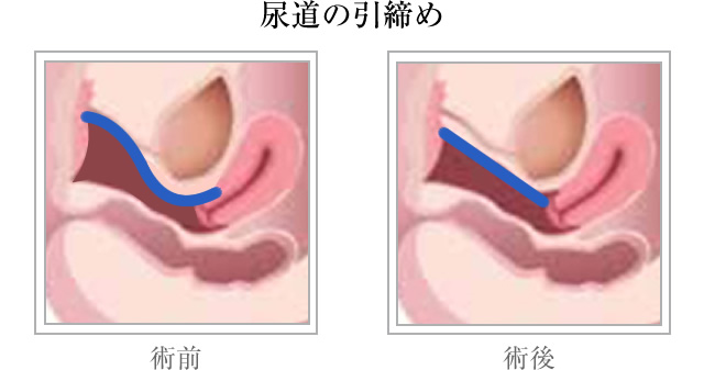 尿道の引締め