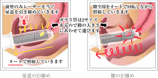 タイトニング