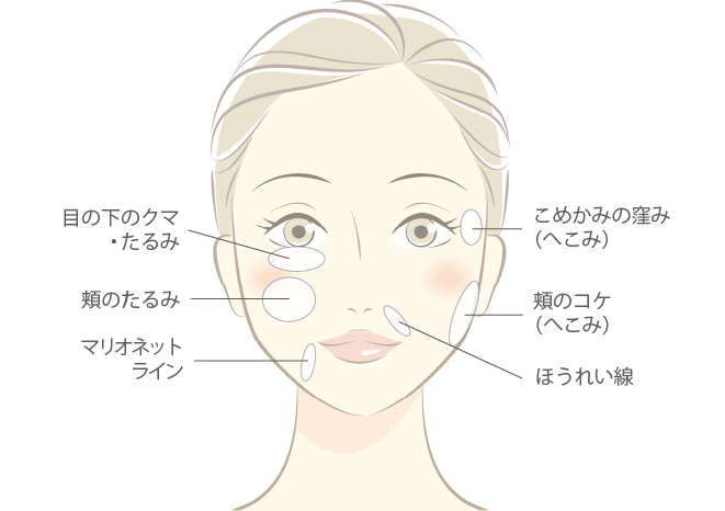 レディエッセ注入はこのような方におすすめです