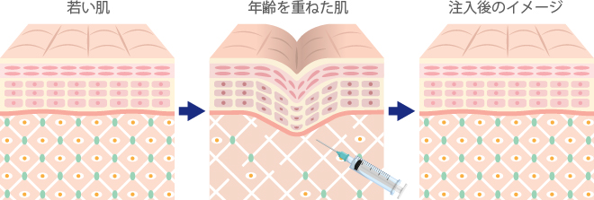 ジュビダーム・ボライトXCによる美肌効果のメカニズム