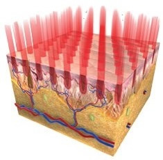 フラクショナルレーザーの照射イメージ