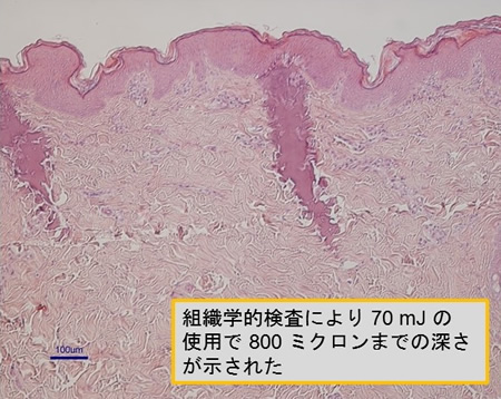 凝固柱・凝固列