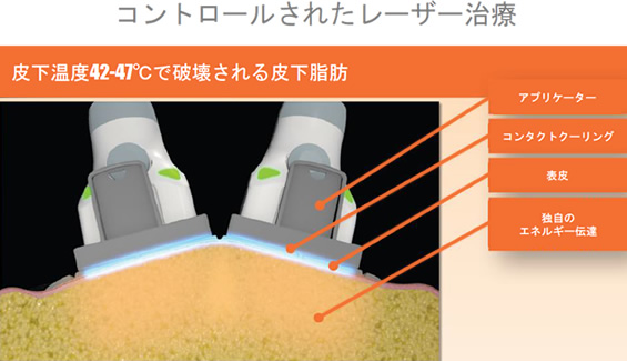 コントロールされたレーザー治療