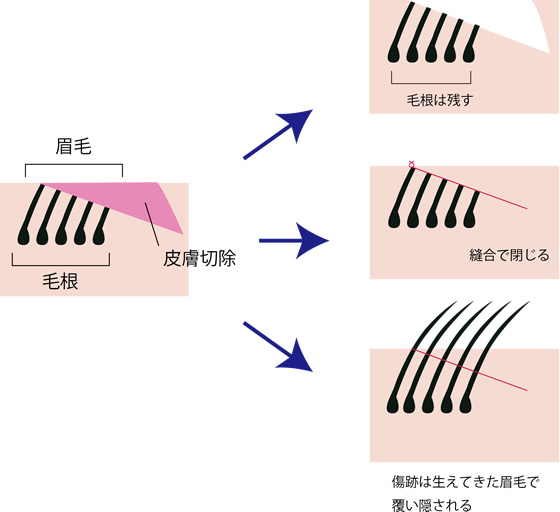 毛包斜切開の原理（切開の断面図）